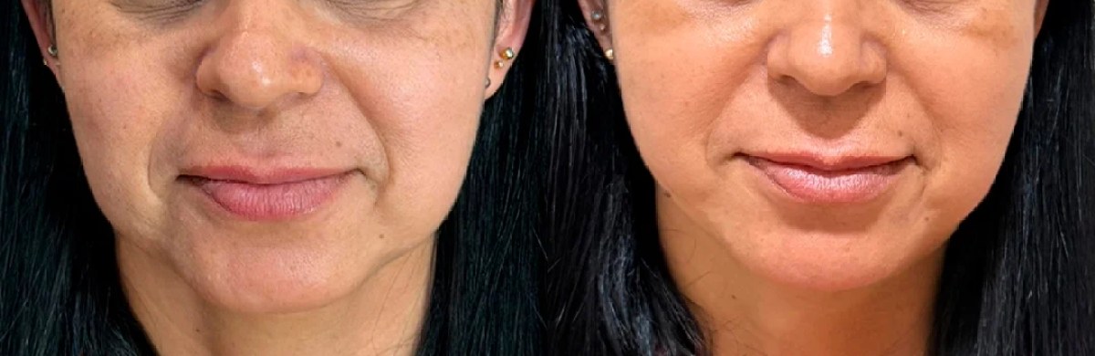 Região média e inferior da face antes e depois do tratamento