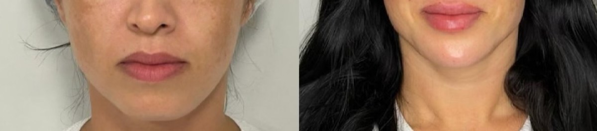 Contorno e lábios antes e depois do tratamento