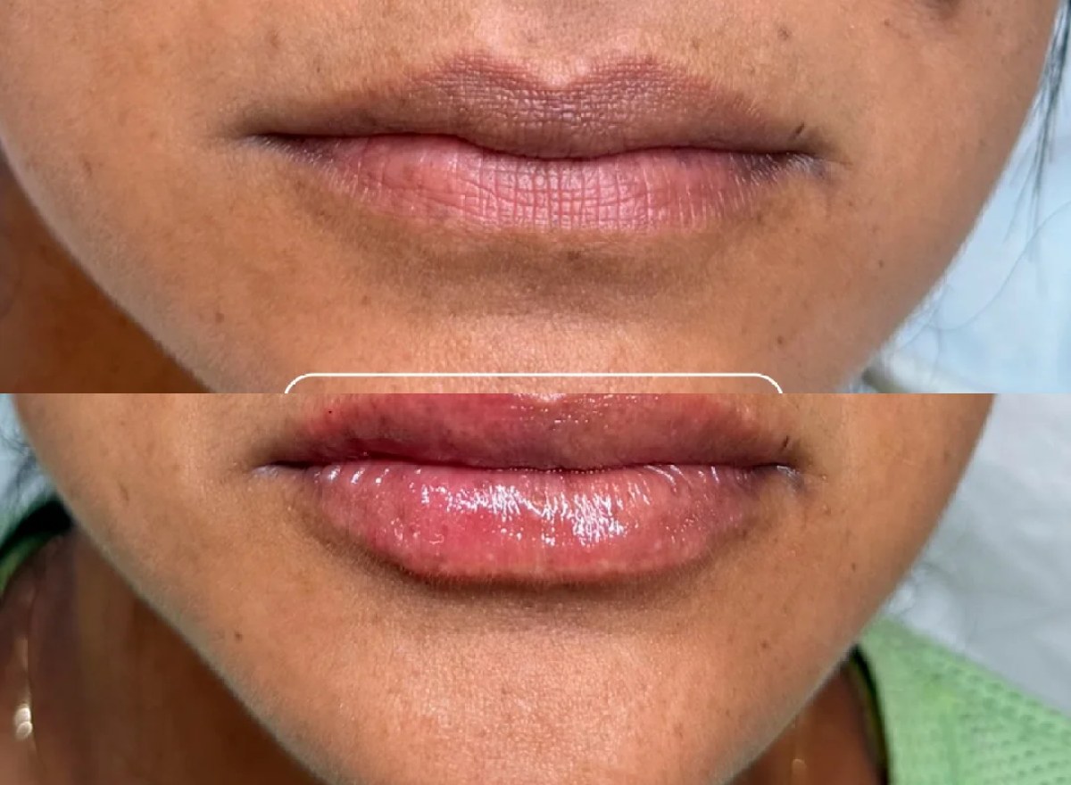 Lábios antes e depois do tratamento