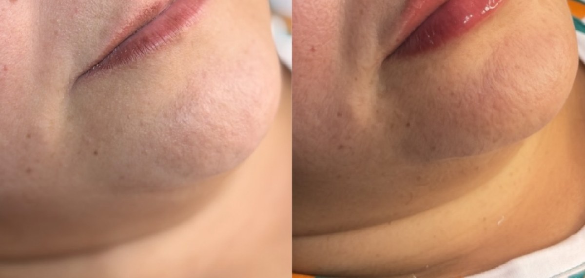 Terço inferior antes e depois do tratamento