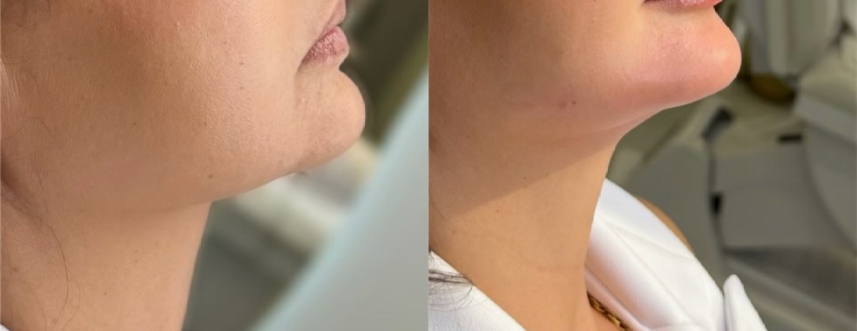 Contorno mandibular antes e depois do tratamento