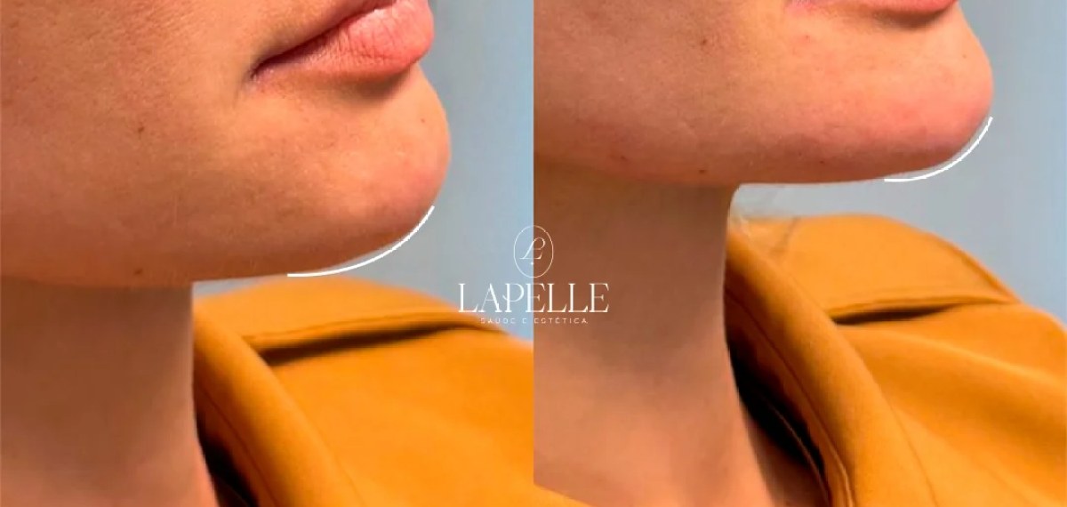 Perfil e mandíbula antes e depois do tratamento