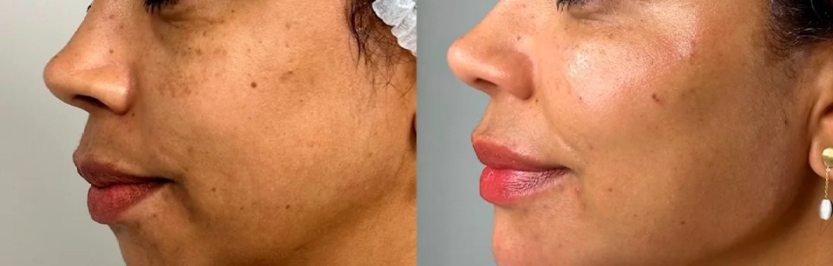 Terço médio e pele antes e depois do tratamento